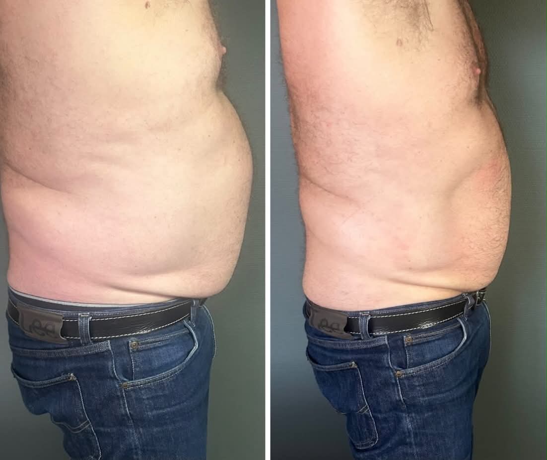 Före och efter – exempel på resultat från M3 + Wonder-behandling